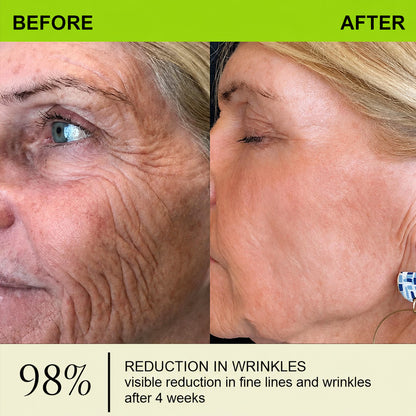 [🔥Last day 70% off] Purelora® Botox and Retinol Injection - Eraser for deep wrinkles, sagging cheeks and puffy eyes