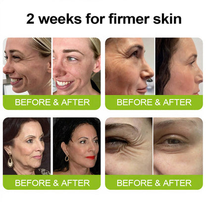 [🔥Last day 70% off] Purelora® Botox and Retinol Injection - Eraser for deep wrinkles, sagging cheeks and puffy eyes