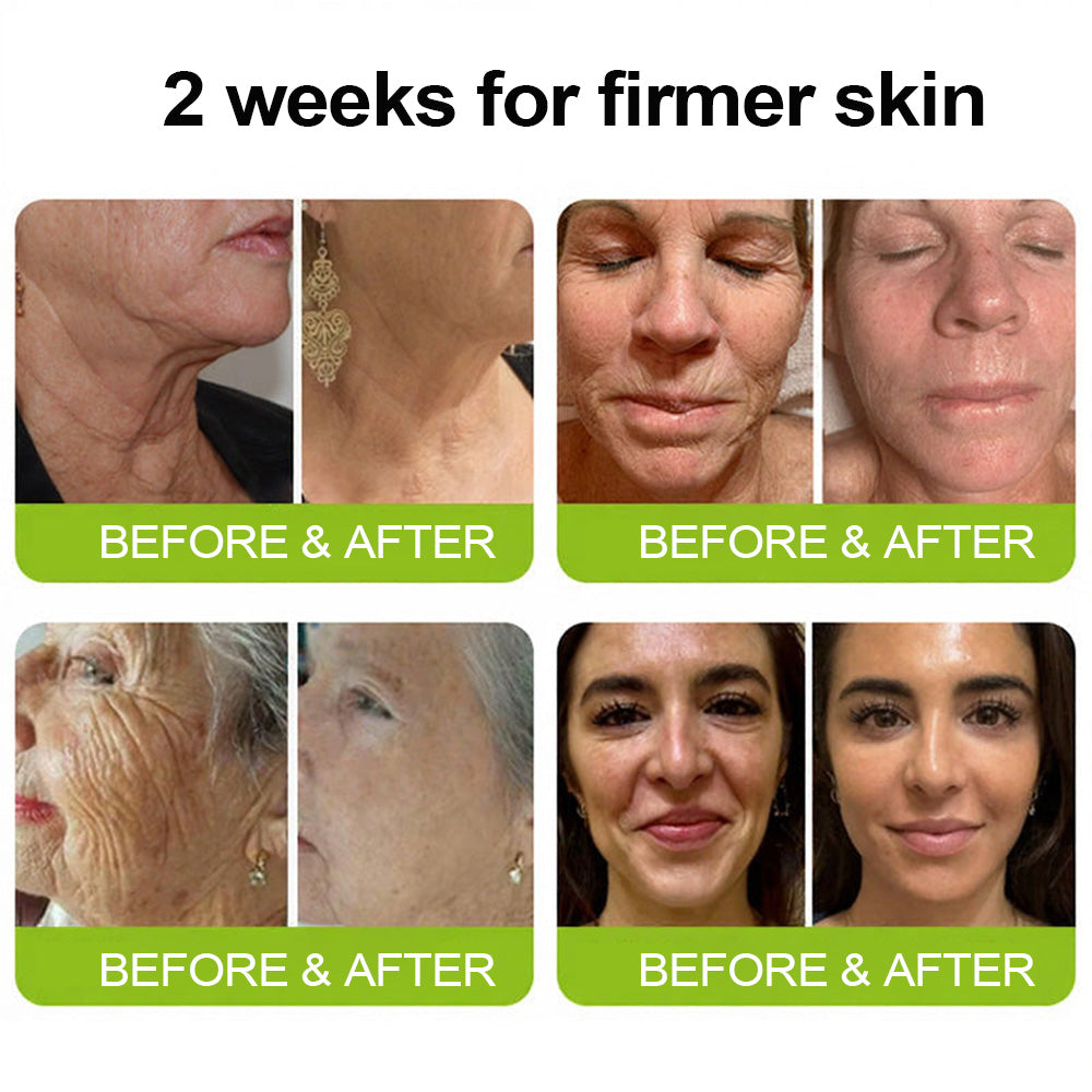 [🔥Last day 70% off] Purelora® Botox and Retinol Injection - Eraser for deep wrinkles, sagging cheeks and puffy eyes